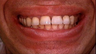 Full Porcelain Crowns