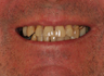 Full Porcelain Crowns