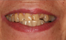Full Porcelain Crowns