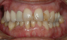 Full Porcelain Crowns