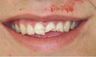 Veneers and crowns