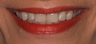 Combination of Veneers and Crowns