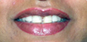 Ceramic Crowns for midline gap