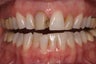 porcelain crowns