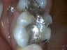Silver Fillings Replaced with Porcelain