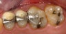 CEREC Restorations