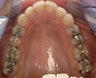 CEREC Restorations