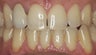 EMAX crown and extreme whitening treatment.
