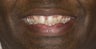 Porcelain Crowns