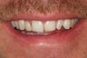 Dental Crown
