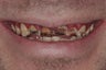 Full Mouth Reconstruction