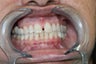 Upper anterior crowns