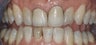 Dental Crowns and Teeth Whitening