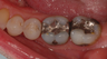 Dental Crowns