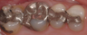 Dental Crowns and Tooth Colored Fillings