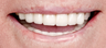 Denture, crown, implant, mercury removal
