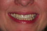 Dental Implants Teeth in an Hour