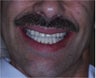 Crown and bridge with implants