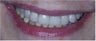 Upper arch reconstruction with implants