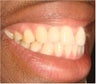 Replacing congenitally missing tooth with Dental Implant