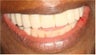 Dental Implants to replace full arch of teeth