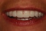 Same day implant supported teeth.