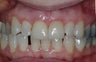 Single implant and crown central incisor