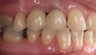 Posterior Implants