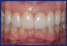 Anterior Implant