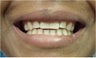 Mini Dental Implants replacing missing front teeth