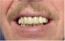 Mini Dental Implants replacing missing teeth