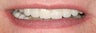 Full mouth reconstruction