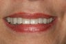 Dental implants, bone grafts, all porcelain crowns