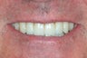 Dental implants, all porcelain restorations