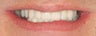 Dental implants, all porcelain crowns