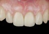 Dental Implants For Missing Front Teeth