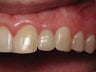 Dental Implant for Missing Lateral Incisor