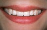 Dental Implant For Missing Front Tooth