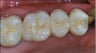 Dental Implants For Missing Back Teeth