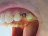 When a tooth fails, what should be done? An implant?