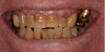 Denture, crown, implant, mercury removal