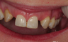 Dental Implants Teeth in an Hour