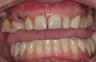 Dental Implants and Dental Veneers