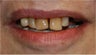 Upper arch reconstruction with implants