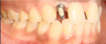 Replacing congenitally missing tooth with Dental Implant