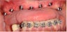 Dental Implants to replace full arch of teeth
