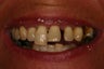 Same day implant supported teeth.