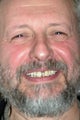Full mouth reconstruction with dental implants