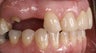 Posterior Implants