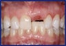 Anterior Implant